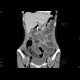 Volvulus, torsion of ileum, ileus: CT - Computed tomography
